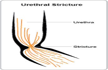 Urethral Stricture Urethral Stricture