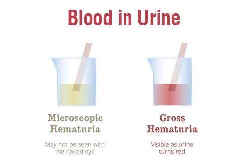 types of hematuria types of hematuria