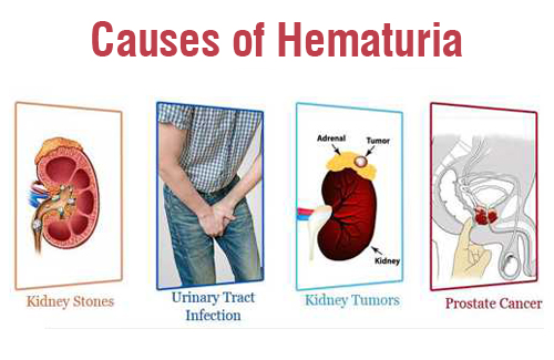 causes of hematuria causes of hematuria