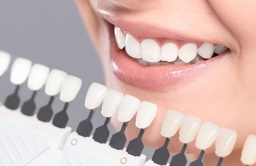Veneers in Turkey - Vaidam Veneers in Turkey - Vaidam