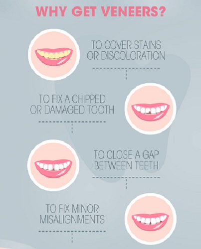 Veneers in Turkey - Vaidam Veneers in Turkey - Vaidam