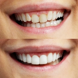 Veneer prices in Turkey - Vaidam Veneer prices in Turkey - Vaidam