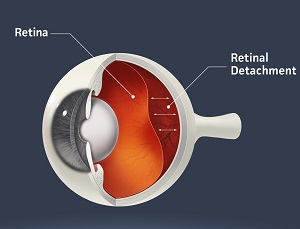 Detached retina