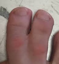 webbed toes webbed toes