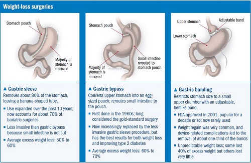 weight loss surgery in Turkey weight loss surgery in Turkey