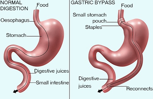 weight loss surgery in Turkey weight loss surgery in Turkey