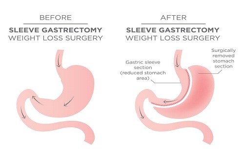 weight loss surgery in Turkey weight loss surgery in Turkey