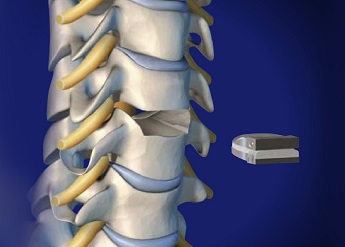Cervical disk replacement surgery procedure