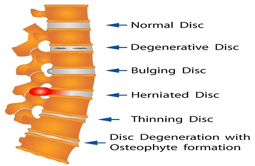 why you need spine surgery why you need spine surgery