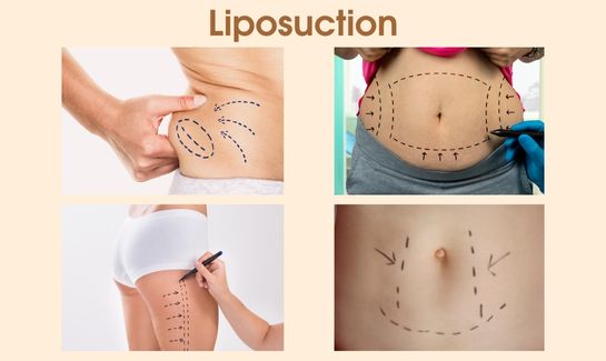 Liposuction