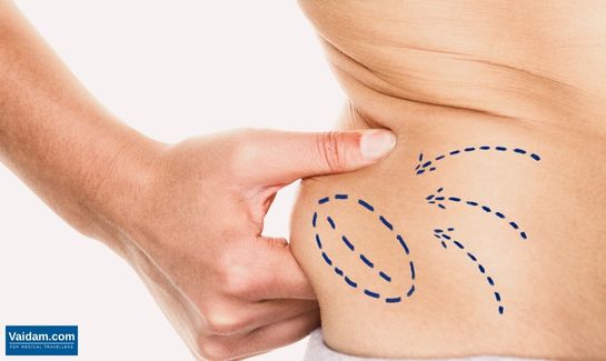 Liposuction