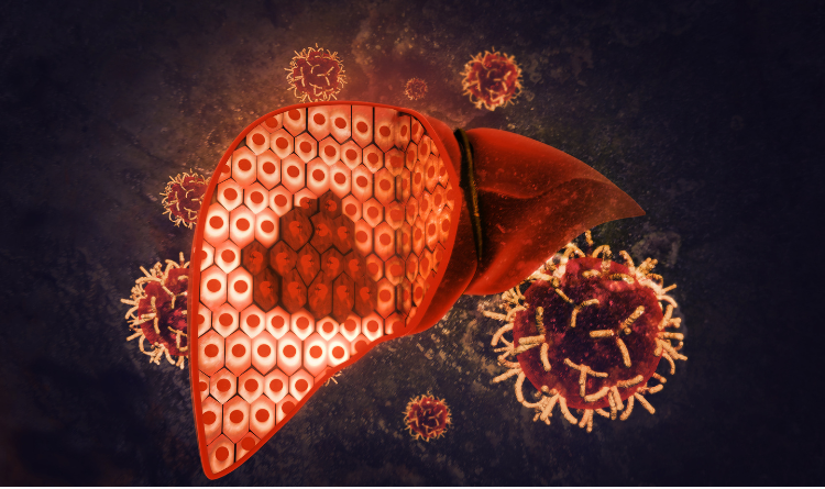 liver cancer