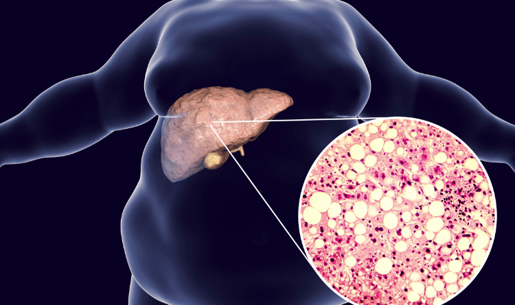 liver cancer