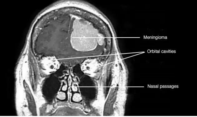 meningioma