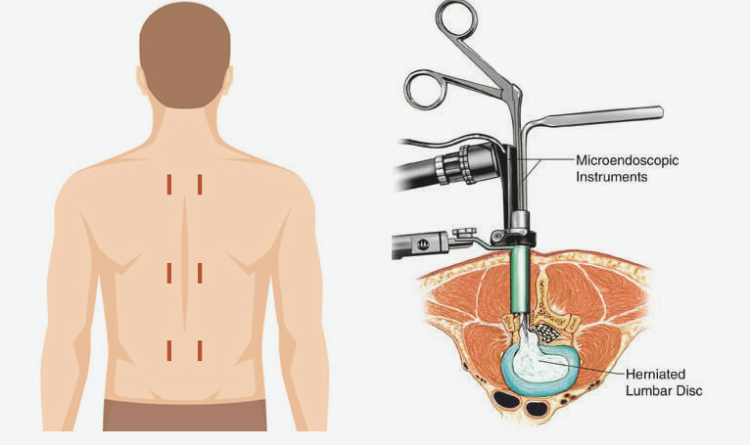 minimally invasive spine surgery