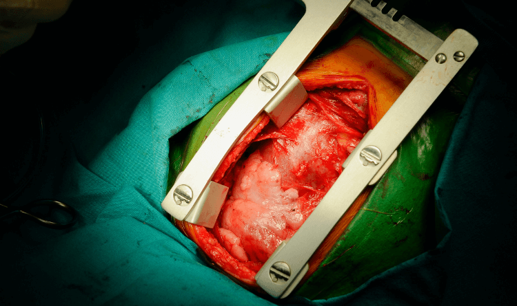 open-heart-surgery