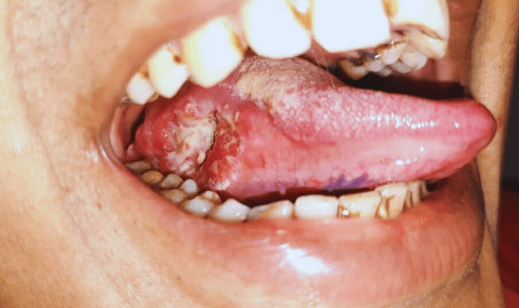 oral-cancer
