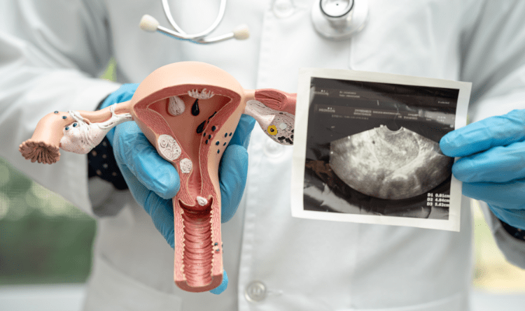 pcos treatment