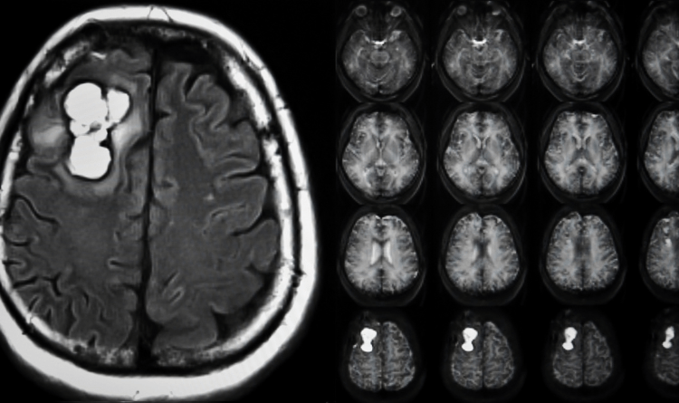 pituitary