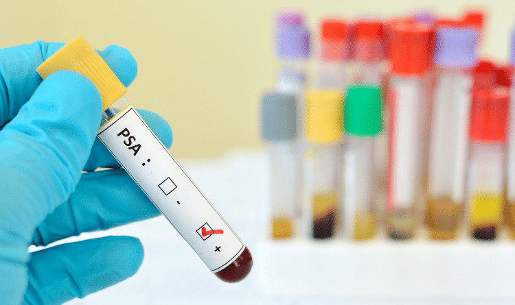 prostate specific antigen test