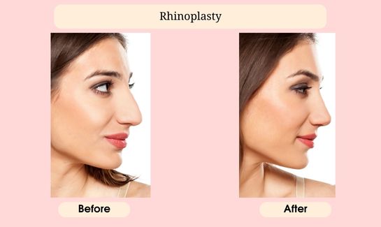 Rhinoplasty 