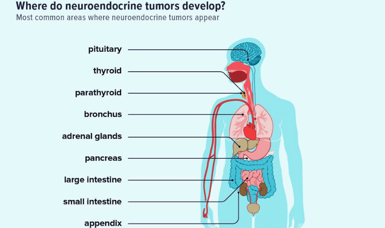tumor