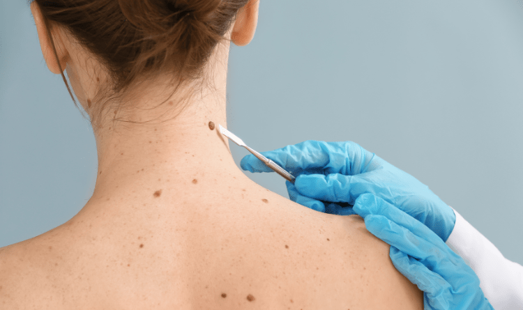skin cancer signs