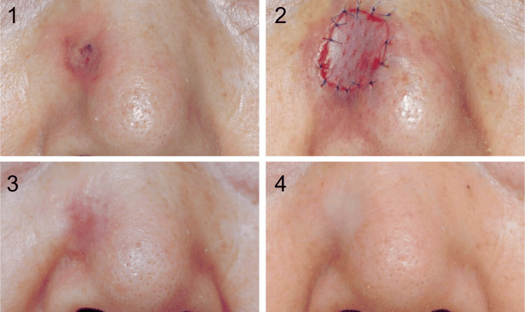 skin grafting