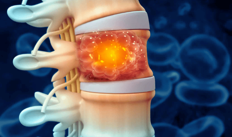 Spinal tumor