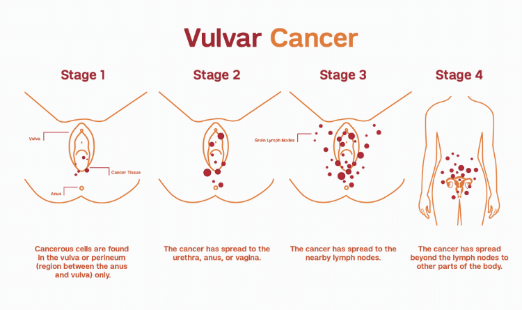 stages