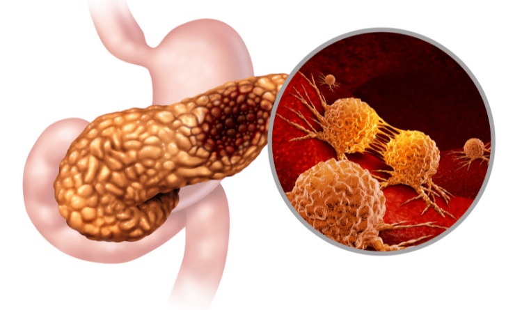 stomach cancer