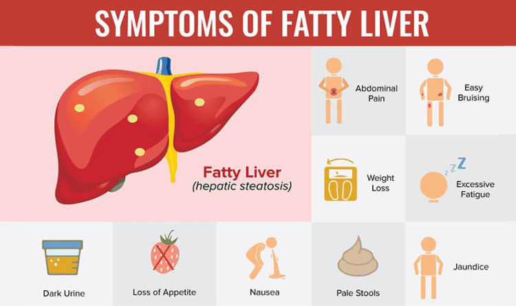 symptoms of fatty liver