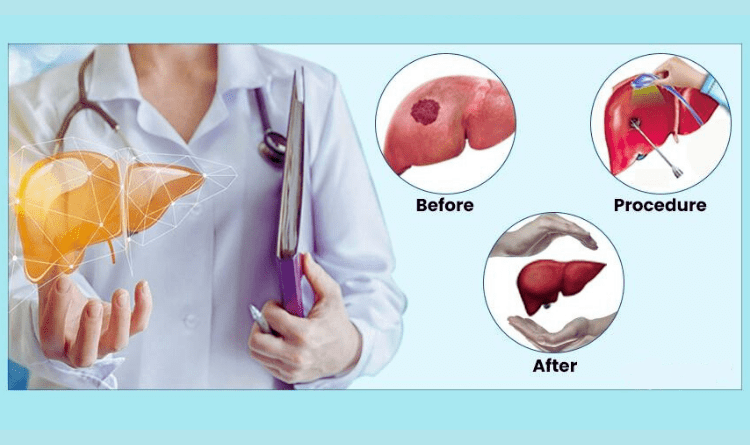 tare for liver cancer