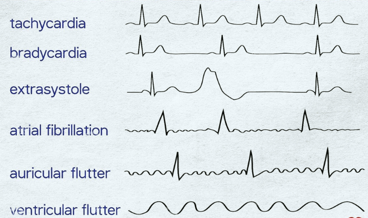 types of arrhythmia