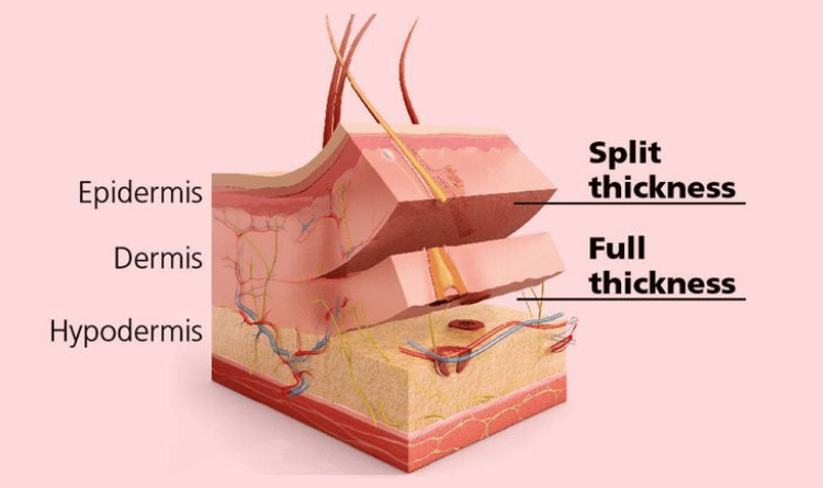 types of skin graft