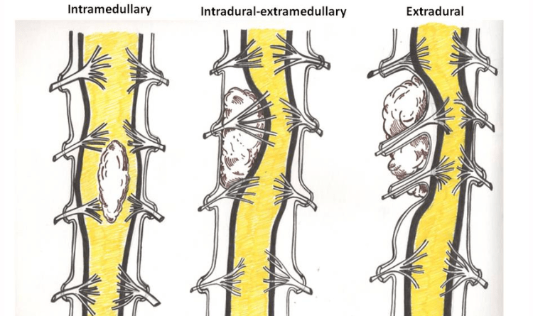 types of spinal tumor