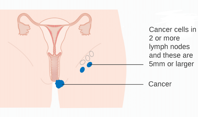 vulvar