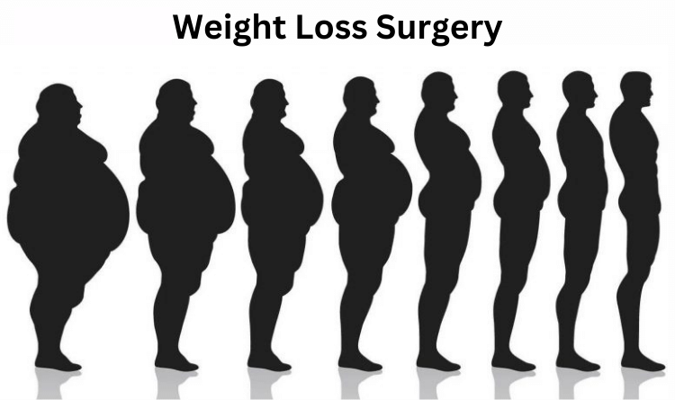 weight loss surgery