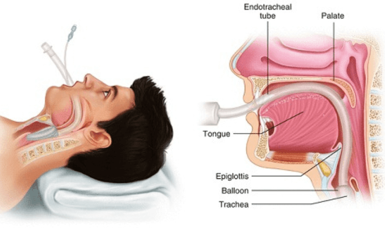 anaesthesia