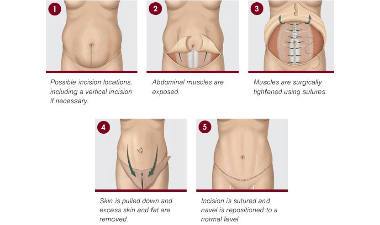 procedure