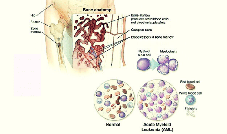 acute myeloid leukemia cells