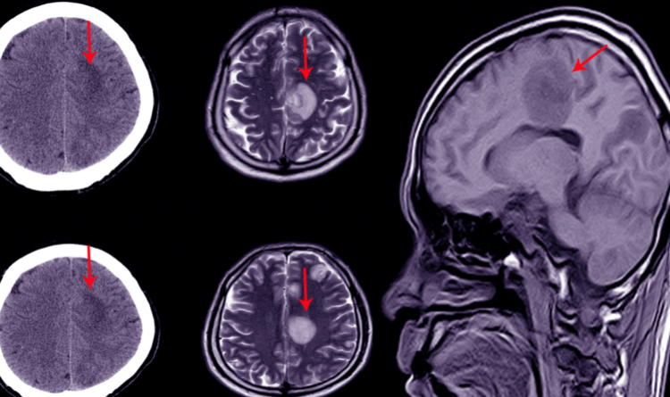 what occurs following brain surgery